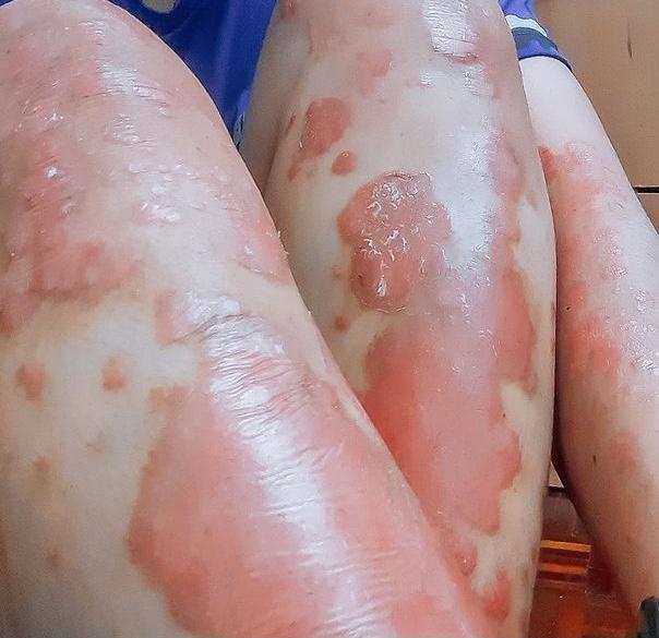 psoriasis