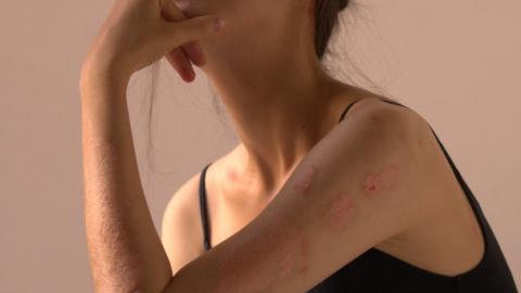 Letters to Psoriasis Fighters #2: Reforming Identity