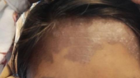 psoriasis skin condition